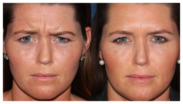 What not to do 24 hours after Botox