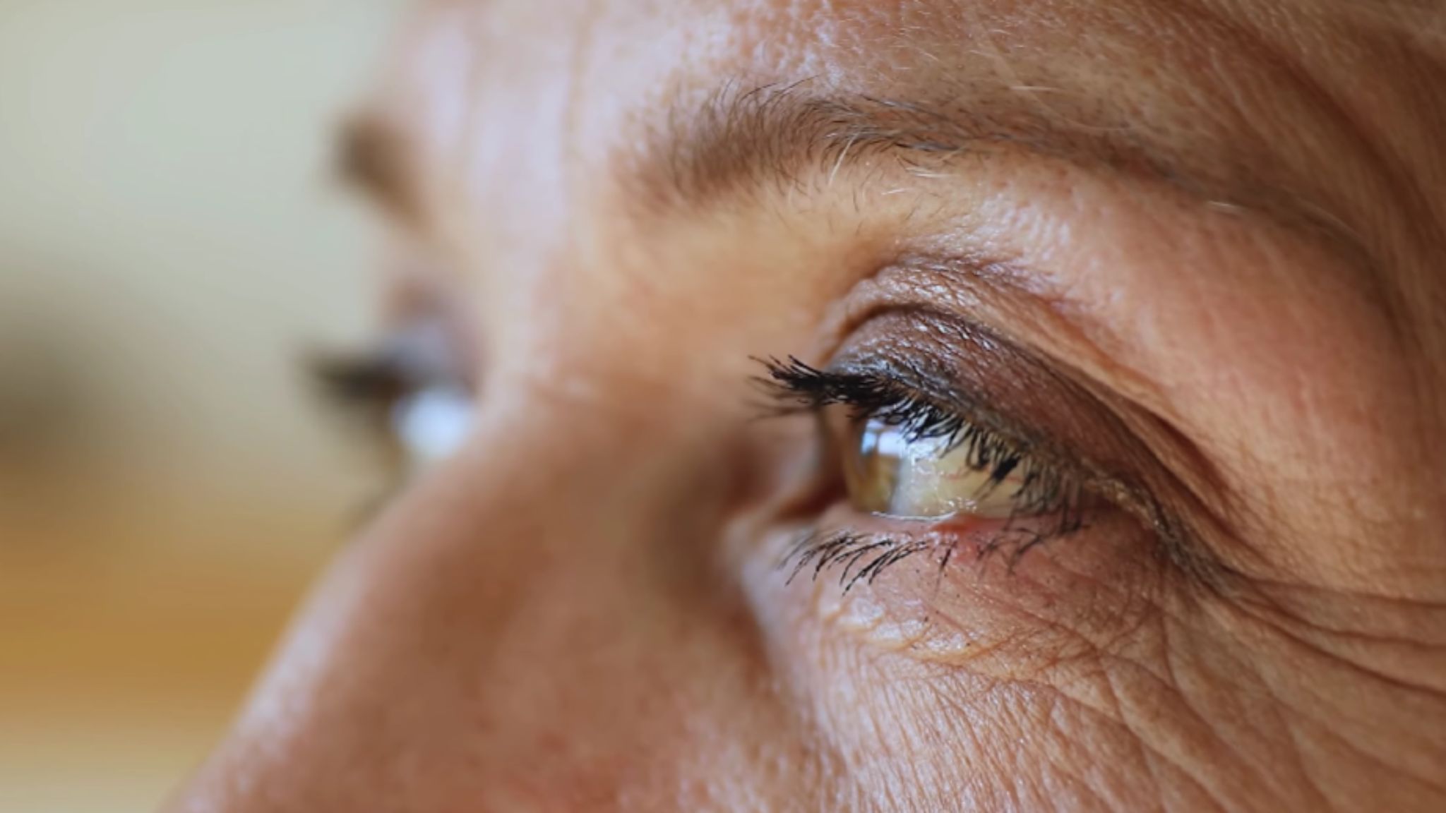 How Effective is Botulax for Crow’s Feet Treatment Details, Results, and Duration