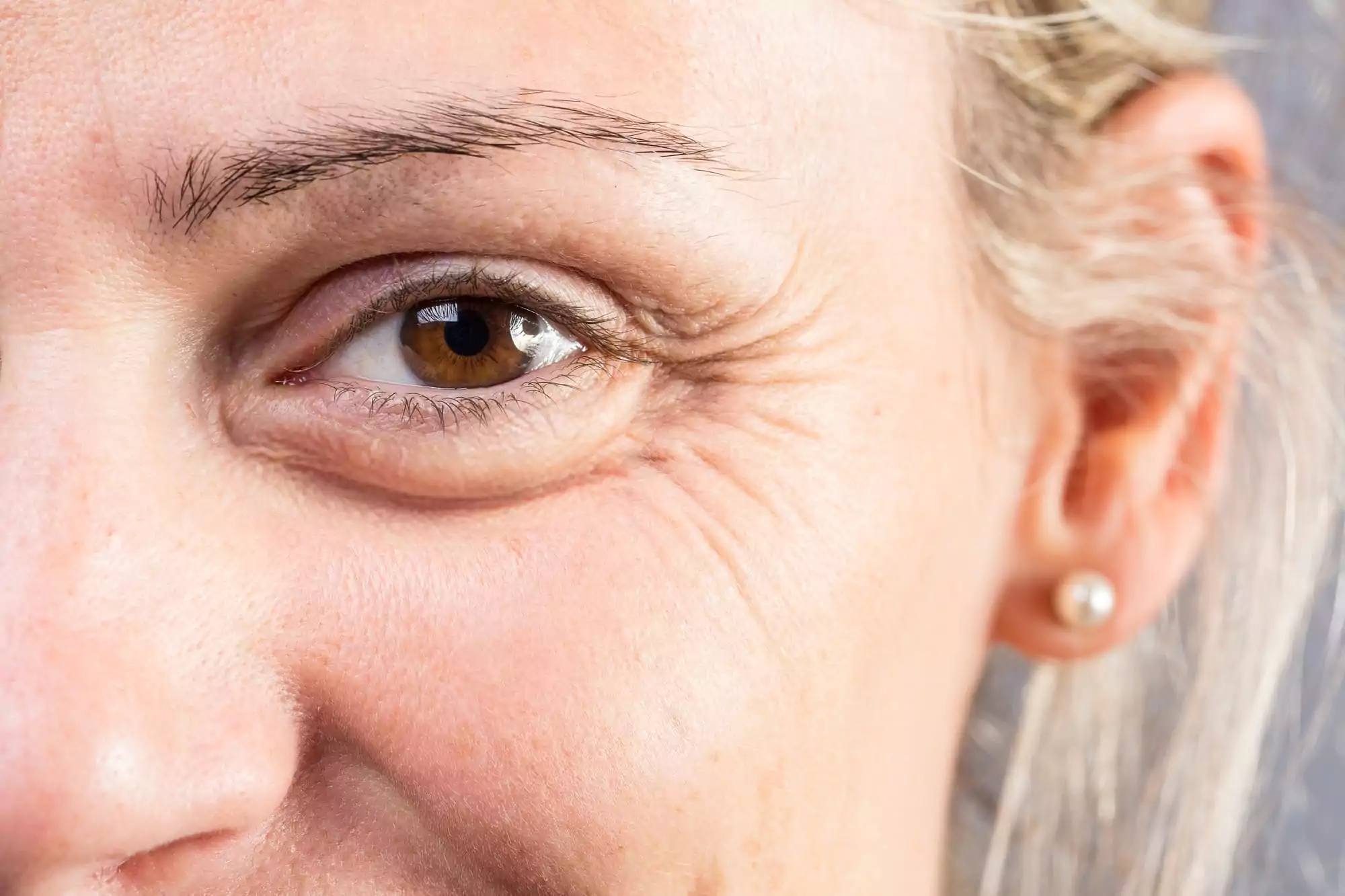 How Effective is Botulax for Crow’s Feet Treatment Details, Results, and Duration