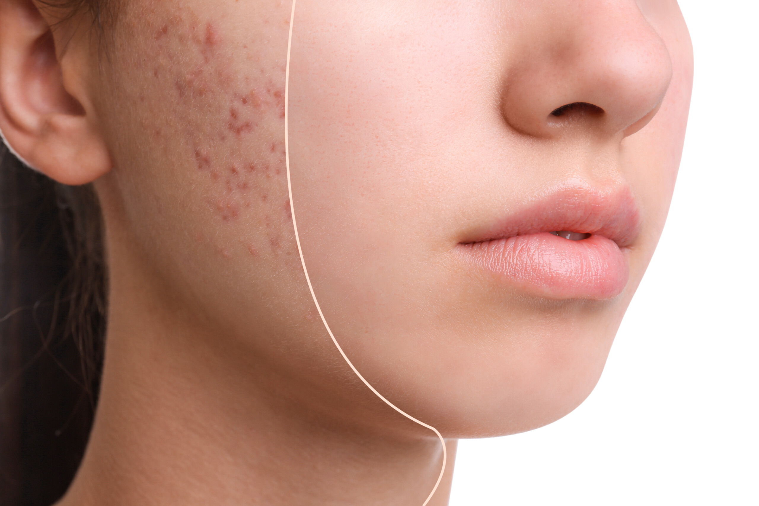 Rejuran I vs Rejuran S Under Eye Repair, Acne Scars, and Injection Depth