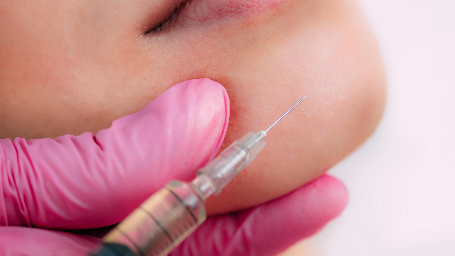 Rejuran S for Acne Scars Scar Texture, Injection Depth, and Expected Results
