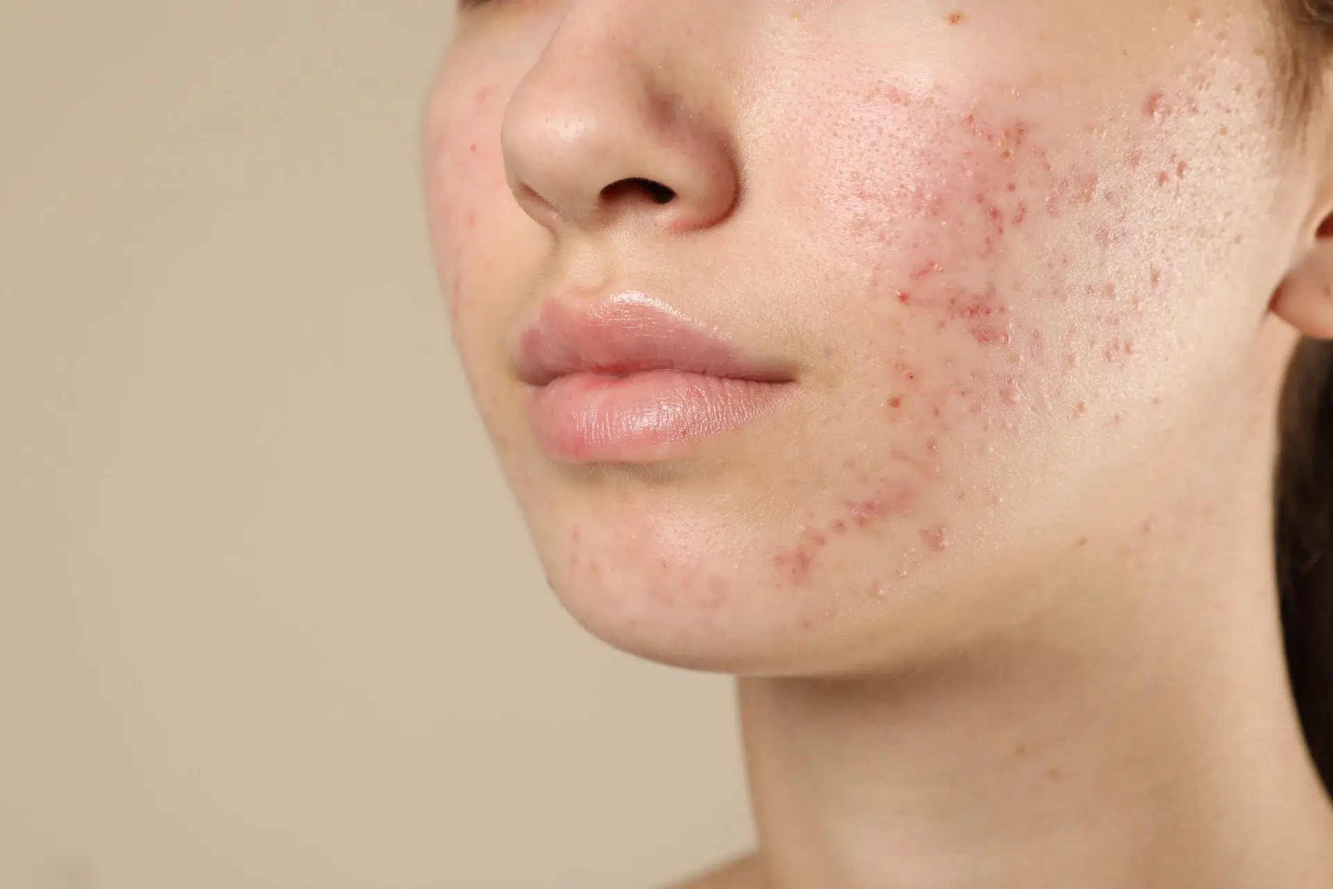 Rejuran S for Boxcar Scars Skin Remodeling, Texture Smoothing, and Results