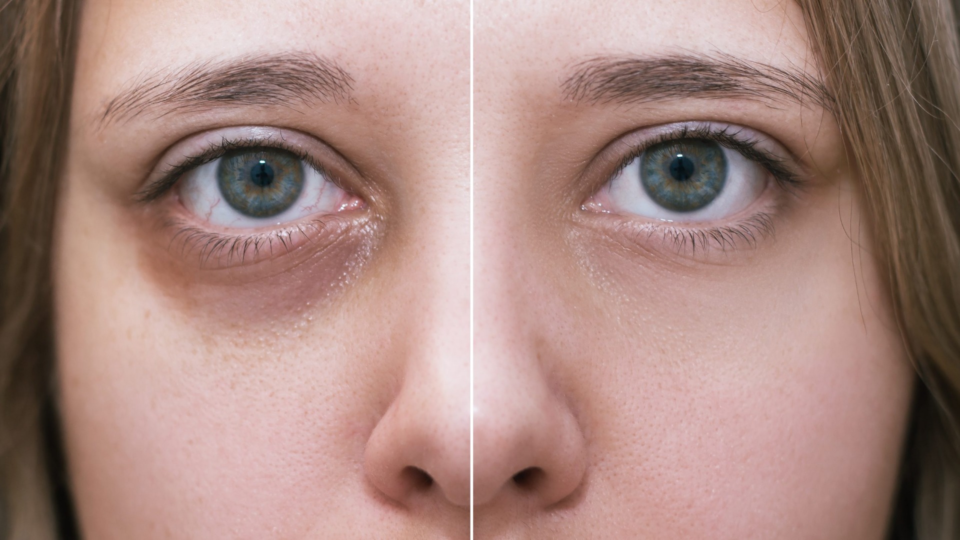 DIVA EYE PN Periorbital Booster Collagen Increase, Dark Circle Reduction, Safety Profile