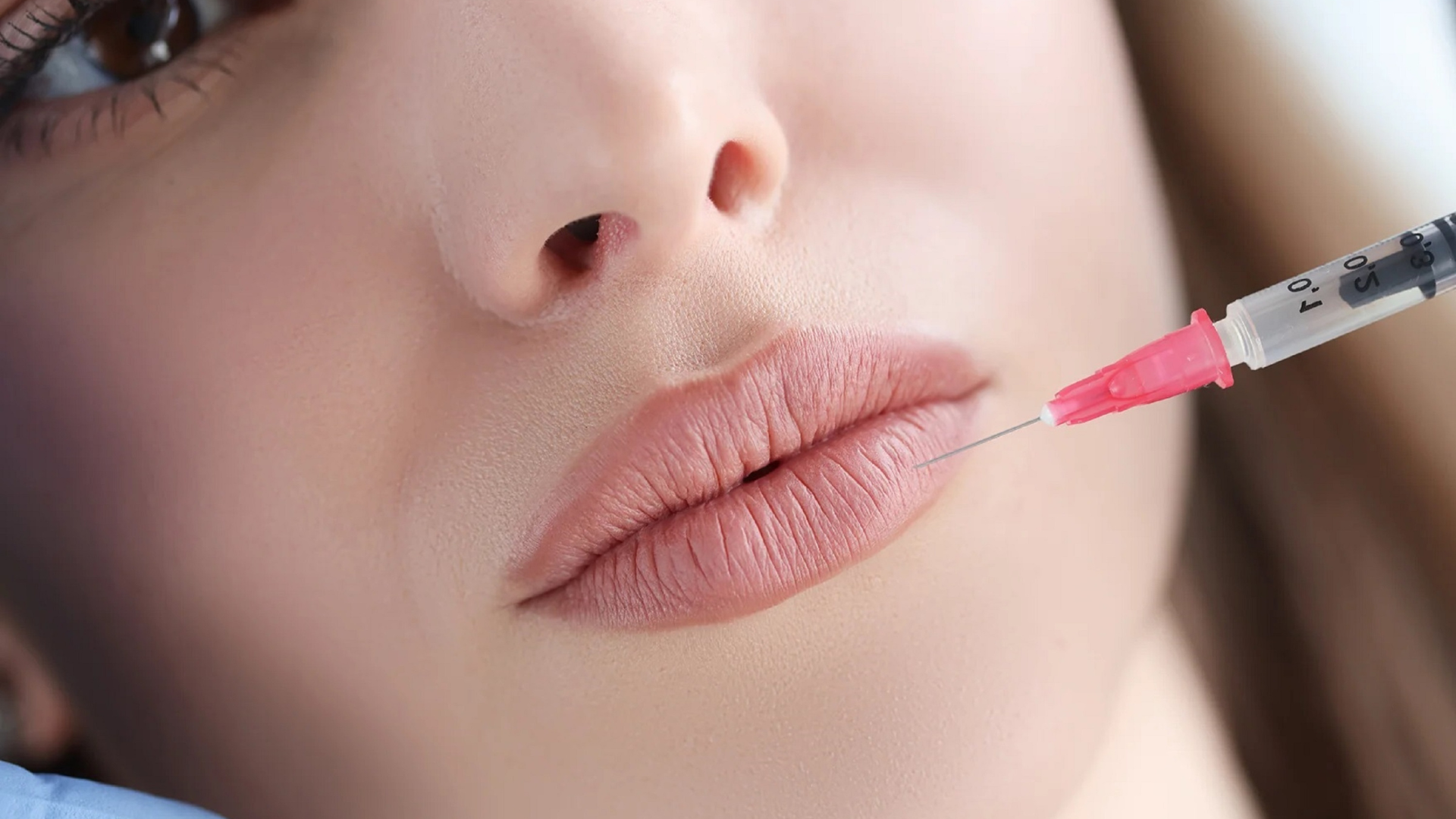 Neuramis Deep vs Revolax Fine Hyaluronic Acid Cross-linking, Lip Filler Efficacy, and Longevity