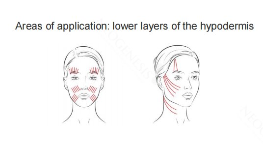 Neogenesis Cog Thread areas of application diagram showing lifting vectors across the cheek, jowl and jawline, placed in the lower layers of the hypodermis