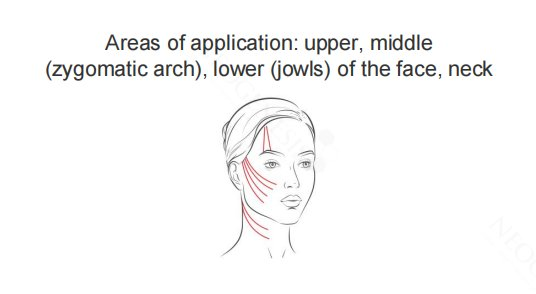 Neogenesis Combi Cog Thread areas of application diagram showing the upper, middle (zygomatic arch) and lower (jowl) face and the neck