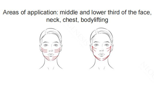 Neogenesis Molding Cog Thread areas of application diagram showing lifting vectors across the middle and lower third of the face and the neck