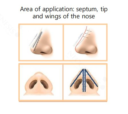 Neogenesis Nose Cog Thread areas of application diagram showing the septum, the tip and the wings (alae) of the nose
