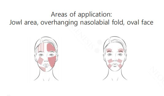Neogenesis Screw Thread areas of application diagram showing the jowl area, the overhanging nasolabial fold and the oval-face contour