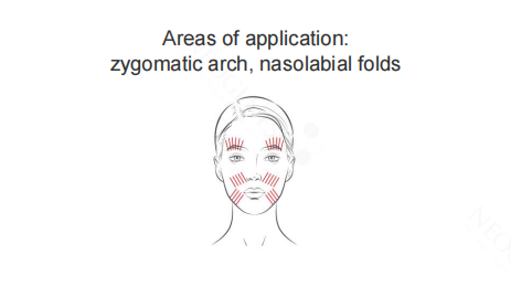 Neogenesis Cavern Thread areas of application: zygomatic arch and nasolabial folds