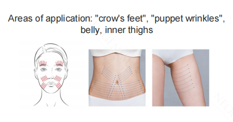 Neogenesis Triple Multi Thread areas of application: crow’s feet, puppet wrinkles, abdomen and inner thighs